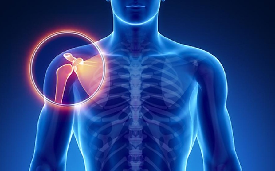 6 DATOS QUE NO SABÍAS SOBRE EL OSTEOSARCOMA