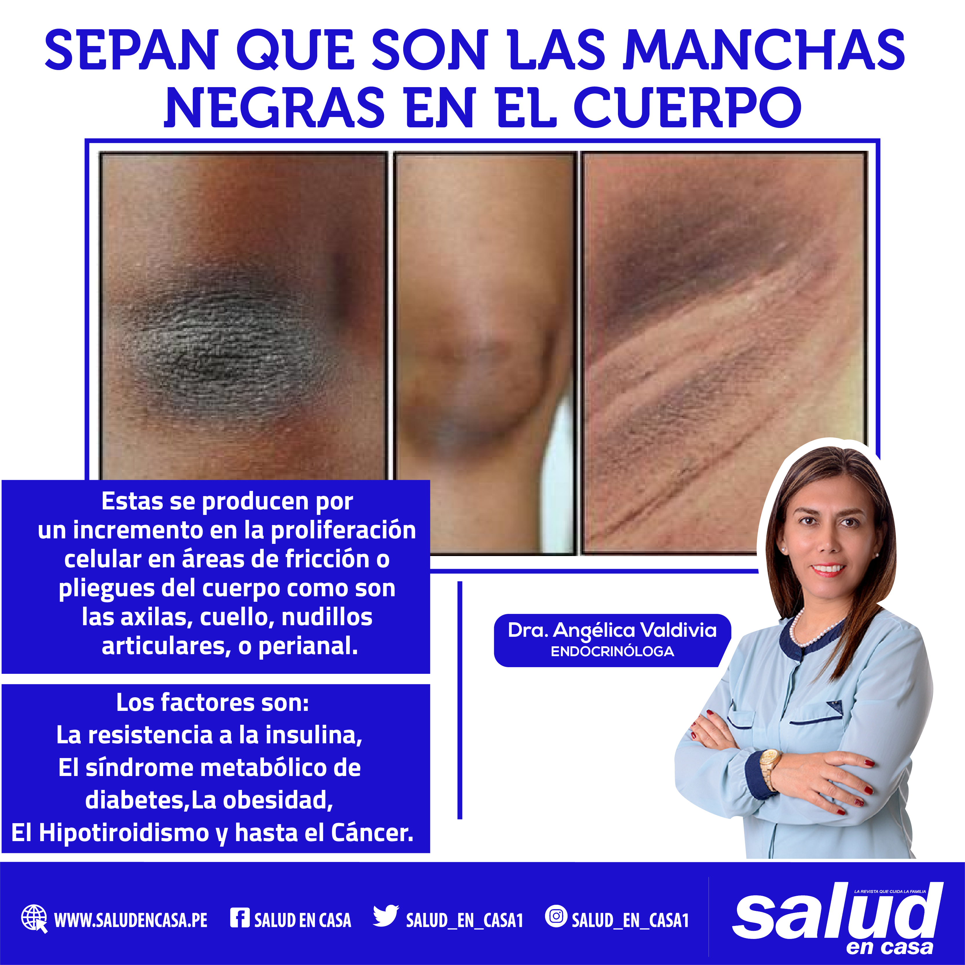 Manchas negras en el cuello, axilas y entrepiernas puede ser el inicio de la diabetes