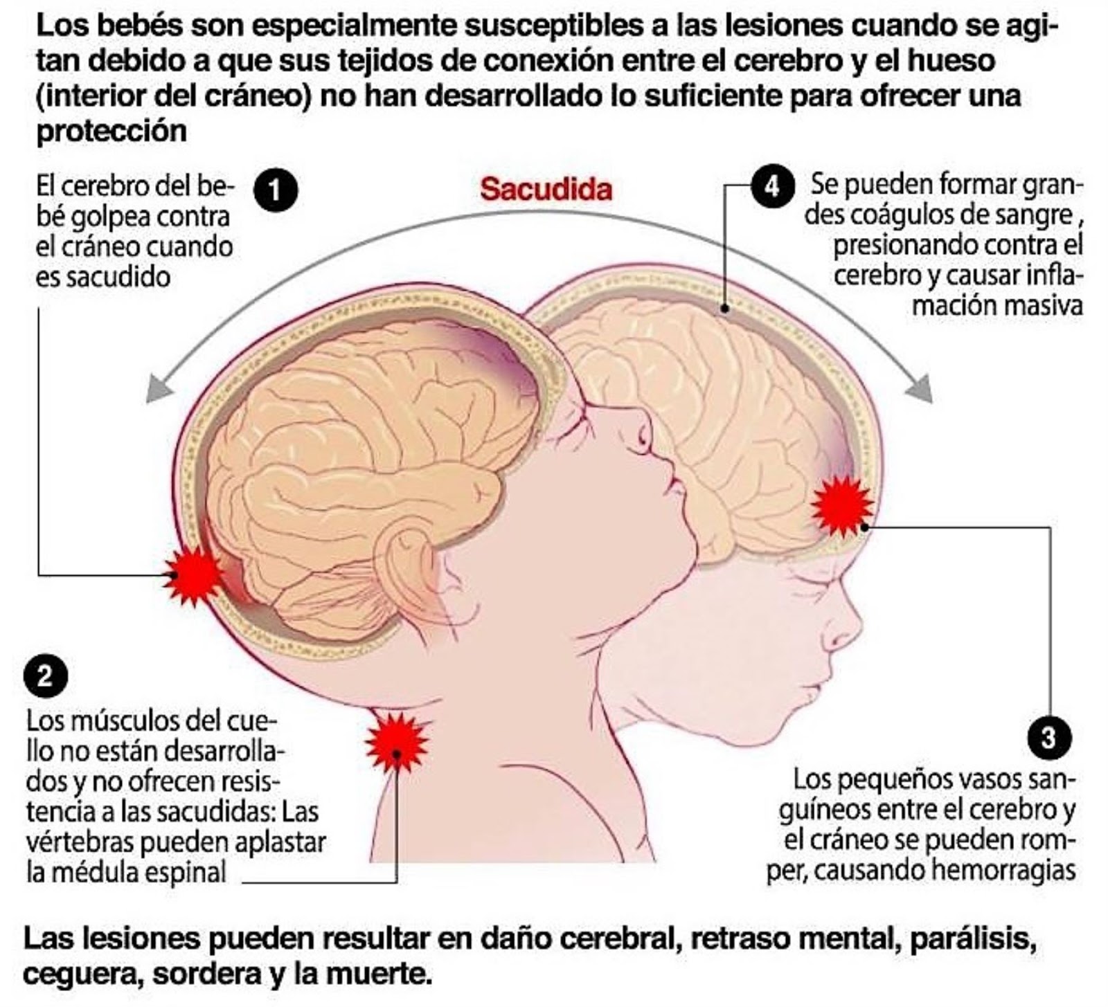 Sacudir a un bebé puede ocasionarle graves daños cerebrales