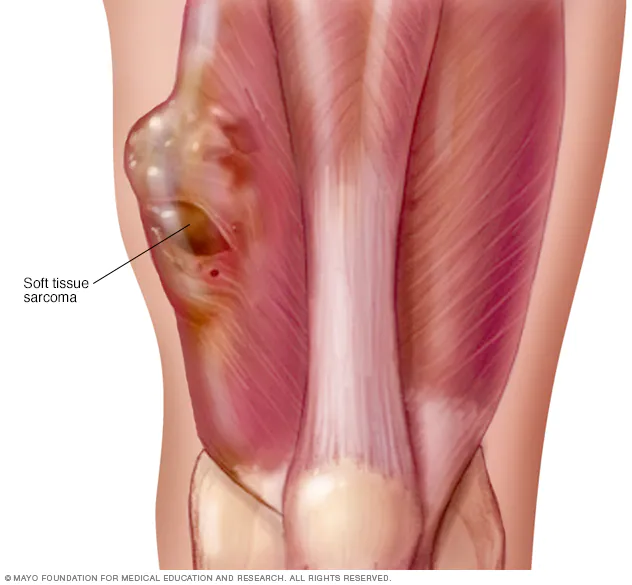 Sarcoma: 4 preguntas clave sobre esta enfermedad