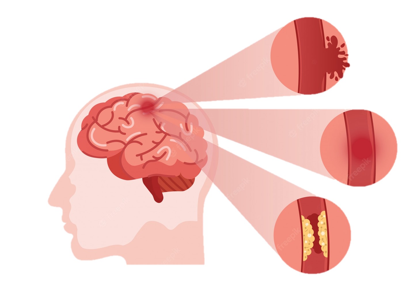 Cinco mitos que existen alrededor del accidente cerebrovascular