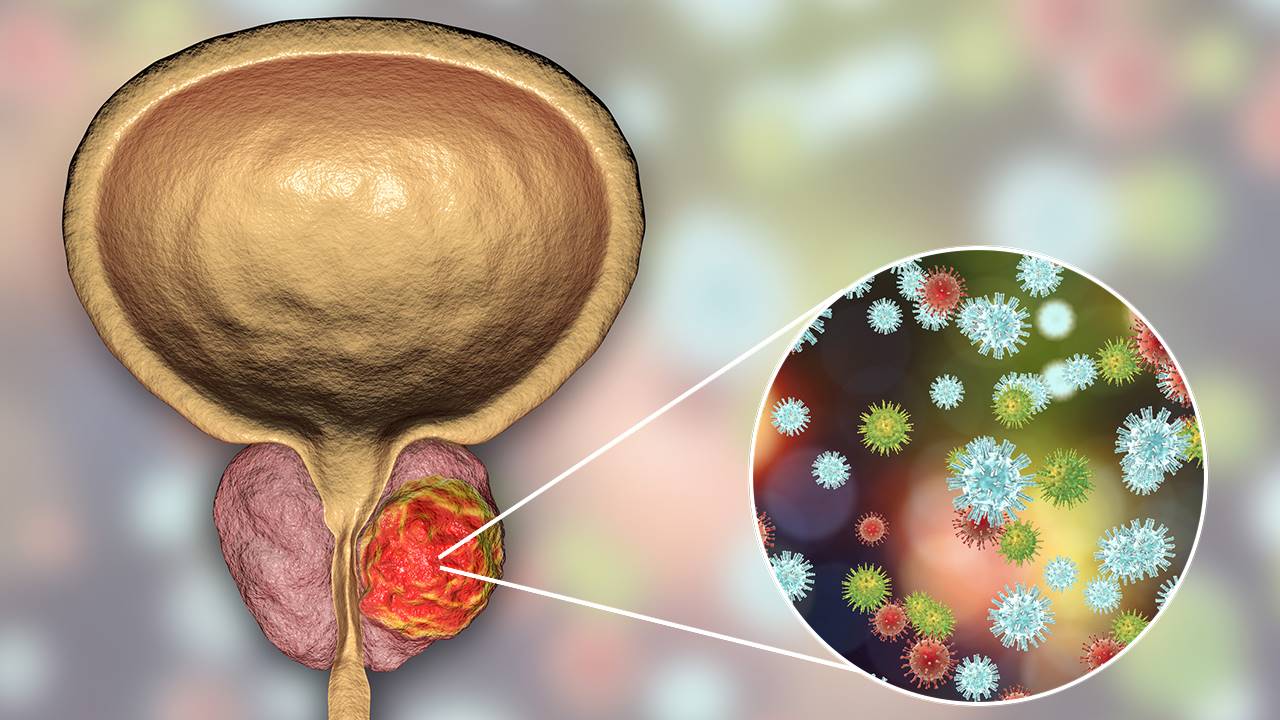 Cáncer de próstata: ¿qué escenarios se pueden presentar luego de la recuperación?