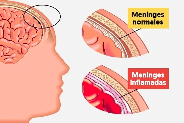 Lanzan campaña para prevenir la Meningitis en todo el Perú