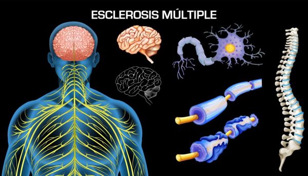 Menos de un tercio de los peruanos con esclerosis múltiple reciben tratamiento 