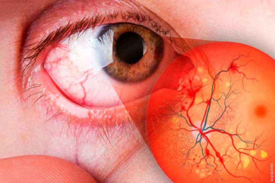 RETINOPATÍA DIABÉTICA PUEDE AFECTAR A LOS DIABÉTICOS CON MÁS DE 10 AÑOS DE DIAGNÓSTICO