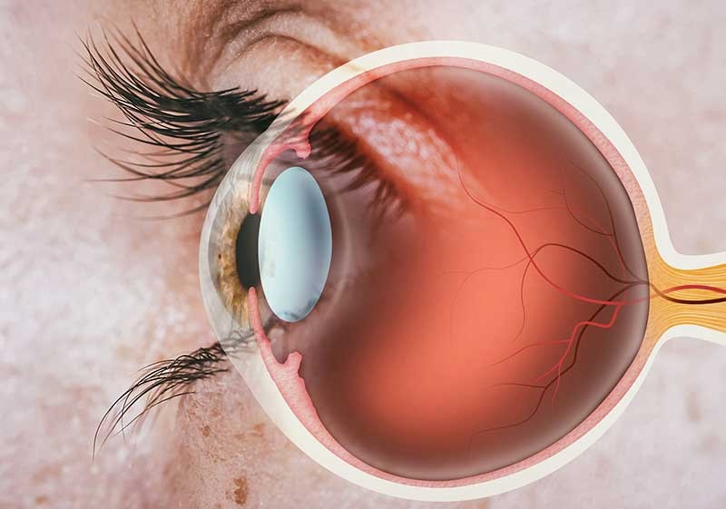 ¿Qué es el edema macular y quienes pueden padecerlo?