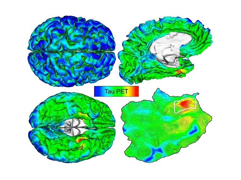 Salud: investigadores desarrollan método para detectar el Alzheimer en etapas tempranas