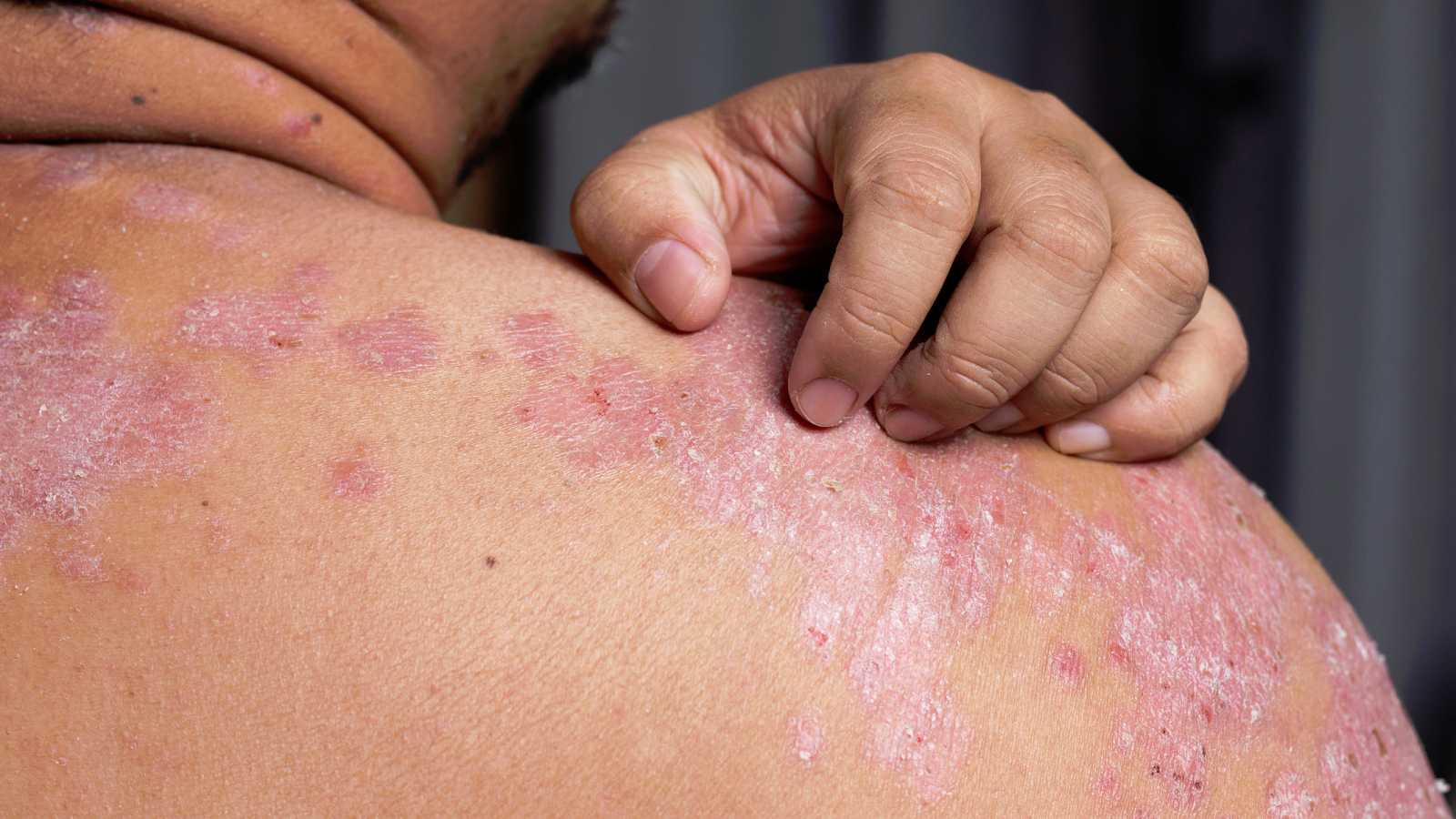 Tratamientos para pacientes con psoriasis no deben posponerse durante la pandemia