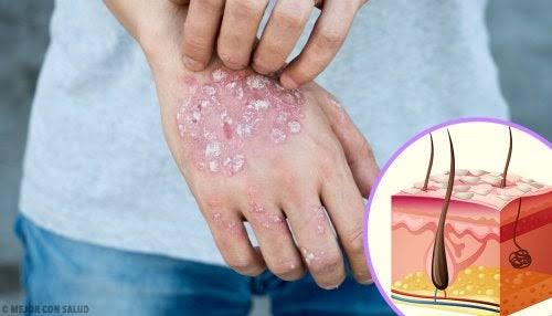 EL CONSUMO DE FRUTAS, VERDURAS y OMEGA 3 ES INDISPENSABLE EN EL TRATAMIENTO DE LOS PACIENTES CON PSORIASIS