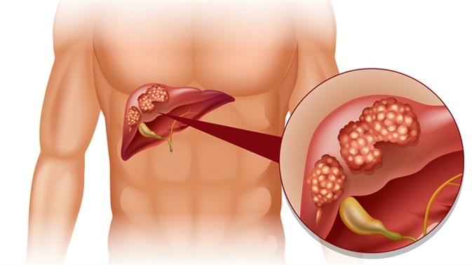 Cáncer de hígado: Perú registra más de 2,174 casos anuales de carcinoma hepatocelular