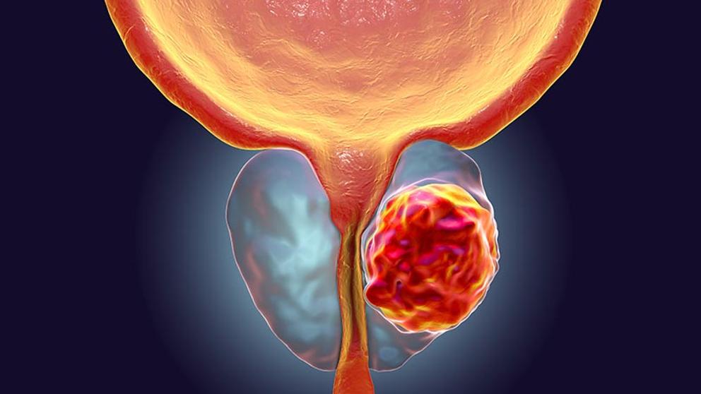 AUMENTAN DIAGNÓSTICOS DE CÁNCER DE PRÓSTATA EN ETAPA AVANZADA