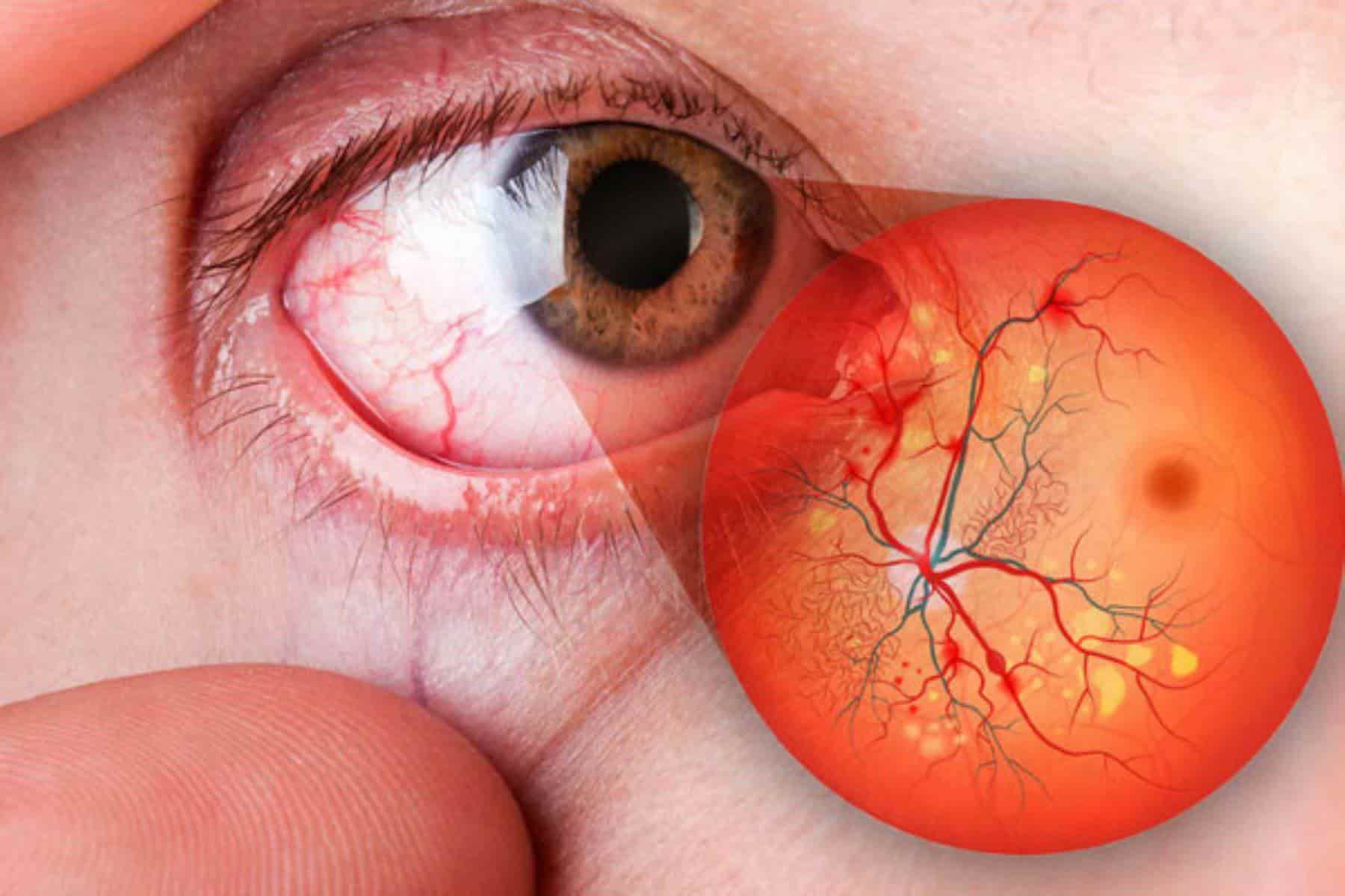 DÍA MUNDIAL DE LA DIABETES: LA PREVENCIÓN DEL EDEMA MACULAR DIABÉTICO ES FUNDAMENTAL PARA LA SALUD OCULAR