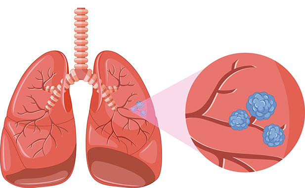 MINSA TRABAJA GUÍA CLÍNICA PARA QUE PERSONAS CON RIESGO POST COVID DESCARTEN CÁNCER DE PULMÓN