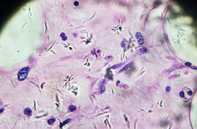 ¿Cuál es la diferencia entre un sarcoma y un carcinoma?