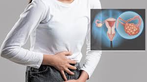 ¿Qué deben saber las mujeres sobre el cáncer de ovario?