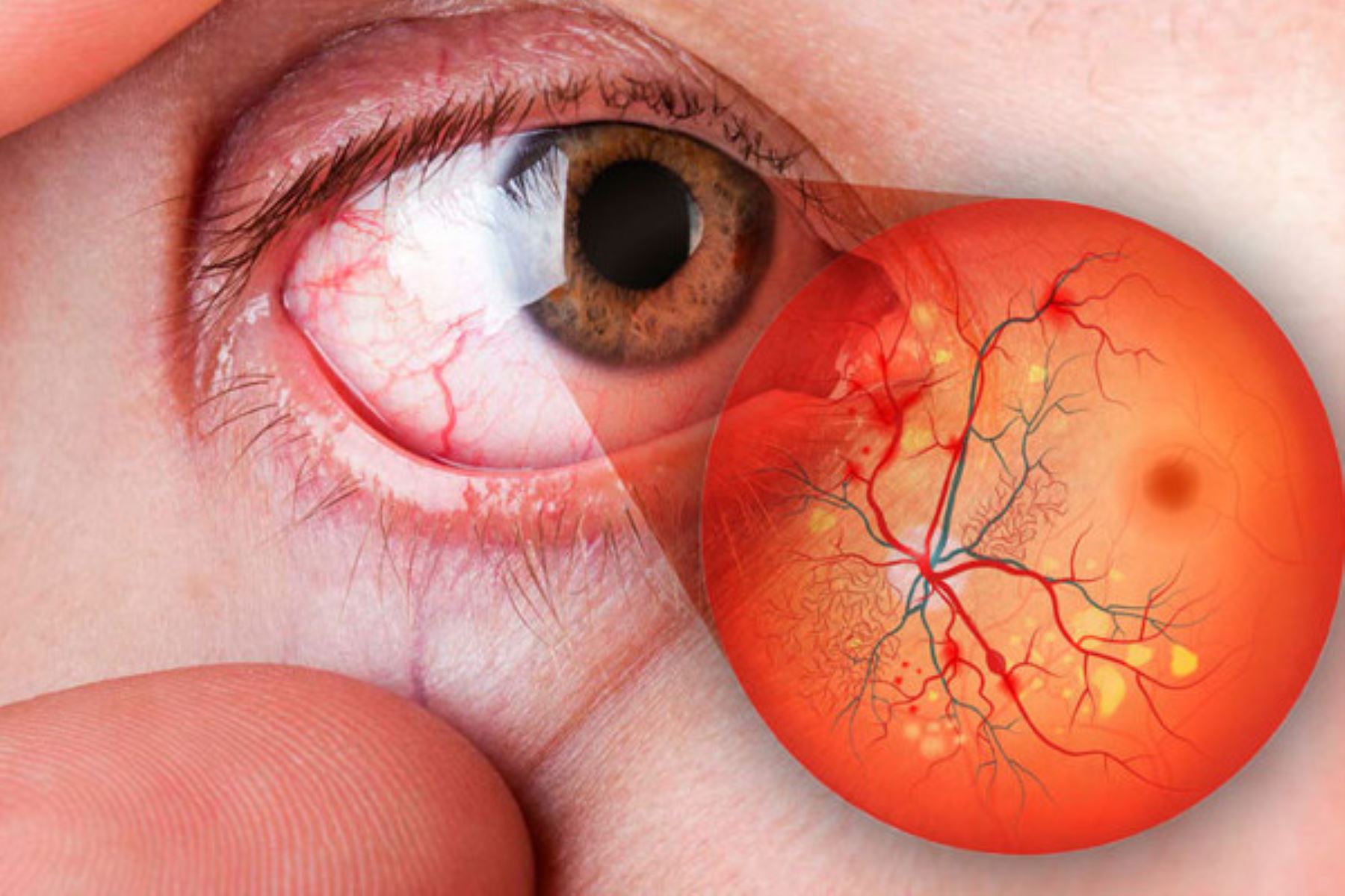 DÍA MUNDIAL DE LA DIABETES: ¿SABEN LOS DIABÉTICOS QUE PUEDEN PERDER LA VISIÓN?